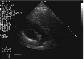 Figure 3 - The pulmonary trunk, identified by its bifurcation