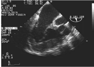 Figure 5 - Transesophageal examination shows the morphological features 