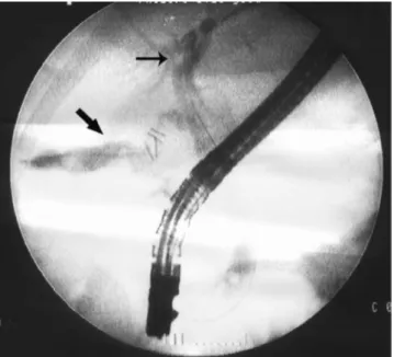 Figure  2- The large arrow indicates the bile duct fistulae, while the thin  arrow indicates stones in the common bile duct