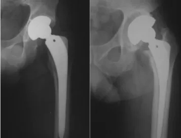 Figure  2  -  Good  radiographic  result  (left)  and  poor  result  (right),  with  lateral rotation center