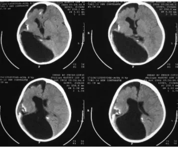 Figure 5 - Post-operative resultsFigure 3 - CT scan of the brain shows: porencephalic cyst, hemiatrophy of 
