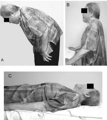 Figure 1 - Patient with camptocormia (A) whose posture markedly improved  when when she was allowed to hold onto a table, (B) or when she lay in a  supine position (C)