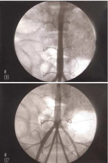 Figure 1 - Angiography after stent deployment in pig aorta
