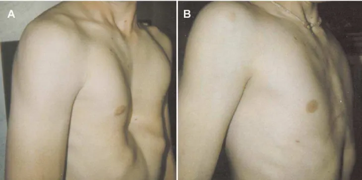 Figure 2 - Measurement of the pectus severity index using a CT scan. This  is calculated by dividing the inner width of the chest at the widest point (a)  by the distance between the posterior surface of the sternum and anterior  surface of the spine (b)