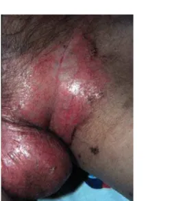 Figure 1 - Erosive scaling and crusted patches on the genital and groin  area
