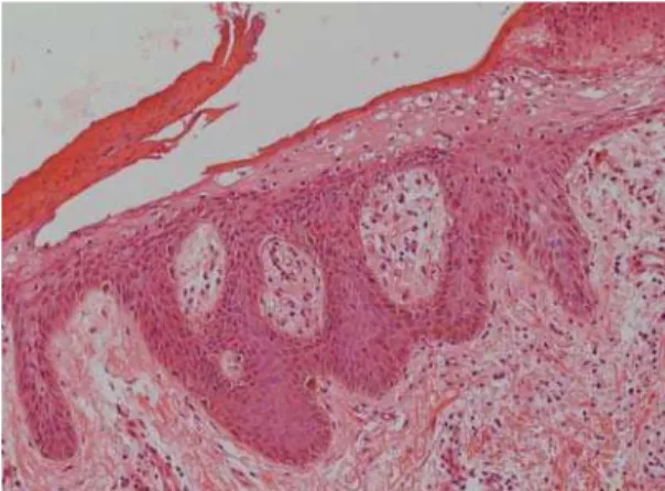 Figure 6 - Vacuolated, pale, swollen epidermal cells and necrosis of the  superficial epidermis