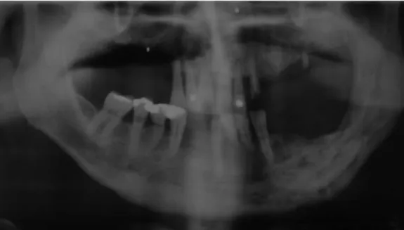 Figure 2 - Panoramic x-ray showing bisphosphonate-induced osteonecrosis in the left jaw