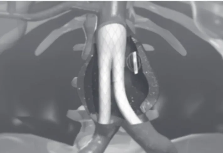 Figure 4 – Visualization of the EndoSure TM  wireless pressure sensor after sac exclusion by the endoprosthesis.