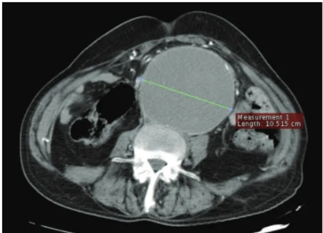 Figure 1 - Thrombosed infra-renal aortic aneurysm