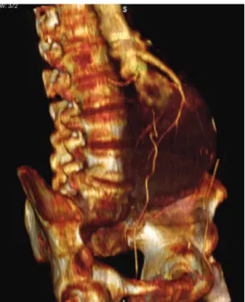 Figure 2 - 3D reconstruction of the thrombosed aneurysm