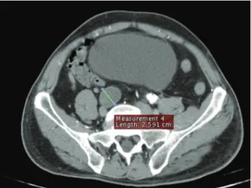 Figure 5 - Thrombosed 2.5-cm right common iliac artery aneurysm