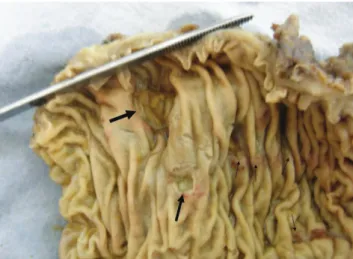 Figure 1 - Thick arrows indicate ulcers and thin arrows indicate macroscopic  mucosal erosions