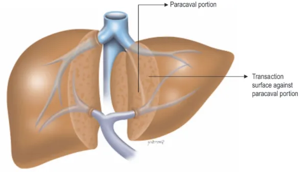 Figure 2 - Anterior approach after opening the interlobar plane and exposing the anterior surface of the paracaval portion and the hilar plate