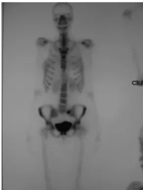 Figure 1 - A bone scan showing the increased uptake in the right sacral region