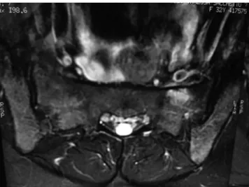 Figure 2 - A magnetic resonance image showing an area with a hypersignal  suggestive of a sacral stress fracture