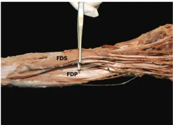 Figure  2  -  Close  view  of  the  connection  between  the  anomalous  tendon  and the FDP tendon to the ring inger