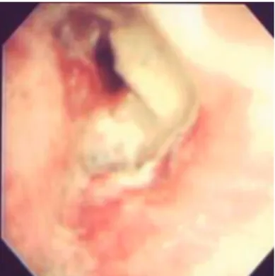 Figure 1 - Endoscopic image of necrosis in the bronchial anastomosis