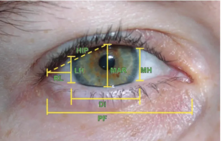 Figure 1 - Standardized eye measures: DI (horizontal diameter of the iris); 