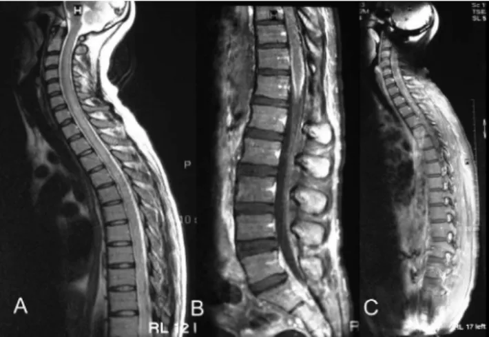 Figure 2 - Non-contrast T2-weighted image showing a diffuse high-signal  intensity inside the cervical and thoracic spinal cord (a)