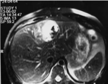 Figure 1 - T2-weighted liver MR image shows a hyper-intense mass located  in segment IV