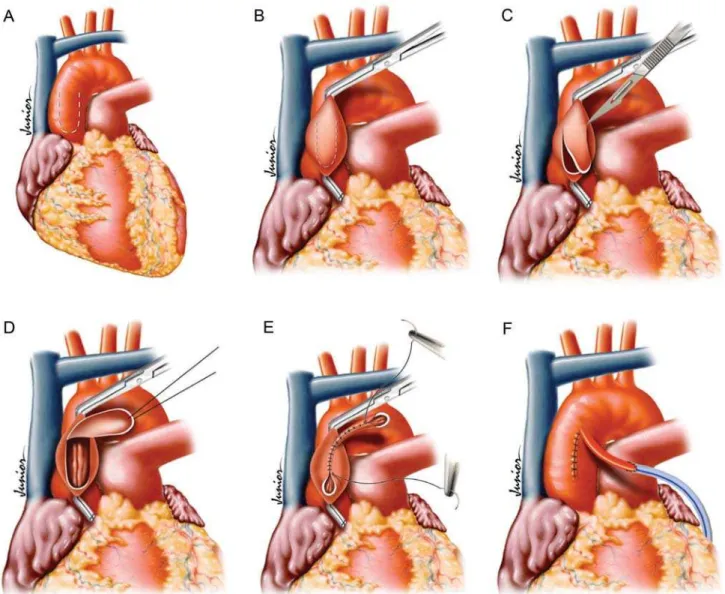 Figure 1 (A-F) - Schematic representation of surgical steps