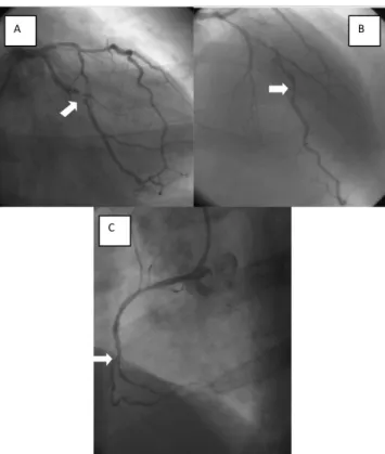 Figure 1 - A. Circumflex coronary artery with 95% obstruction. B. Anterior  descending coronary artery with 70% obstruction