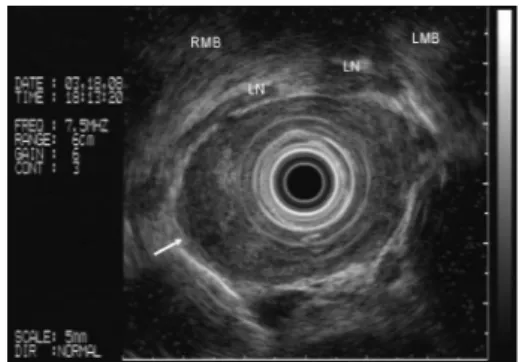 Figure  1  -  Endoscopic  ultrasound:  absence  of  tracheobronchial  invasion  by neoplasia