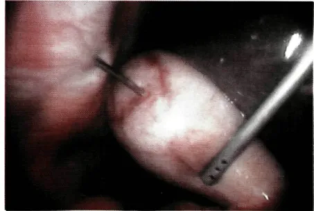 Fig. 2 - Empiema vesicular. Drenagem da bílis vesicular antes da colecistectomia. 