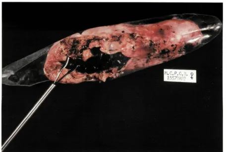 Fig. 3 - Colecistite aguda com litíase múltipla. Extracção da vesícula com saco de plástico