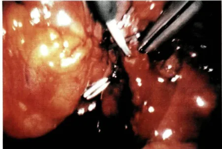 Fig, 4 - Colerístite aguda. Colangiografia per operatória transcística. 