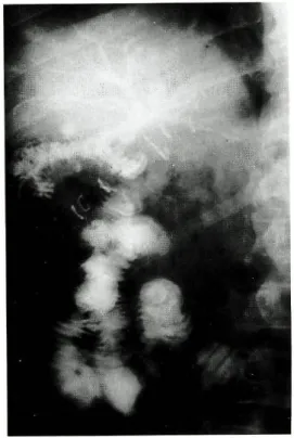 Fig. 8 - Lesão da VBP durante a conversão. Anastomose hepático-jejunal. 