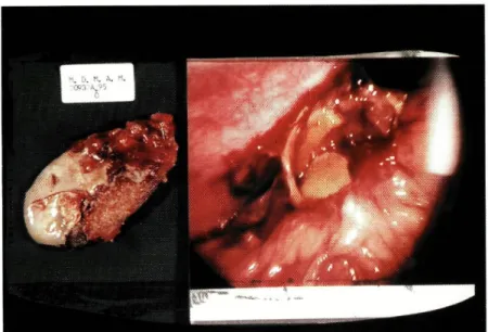 Fig. il - Colecistite Aguda. Imagem operatória da vesícula, num caso de conversão por  hemorragia
