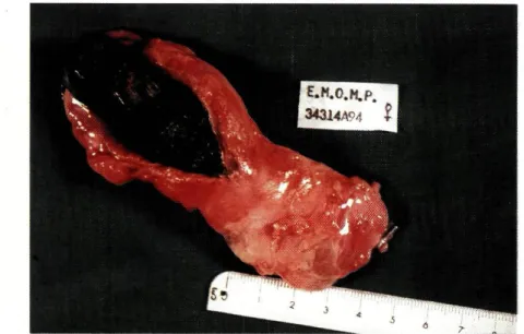 Fig. 15 - Colecistite Aguda com vesícula repleta de cálculos extraída por laparoscopia