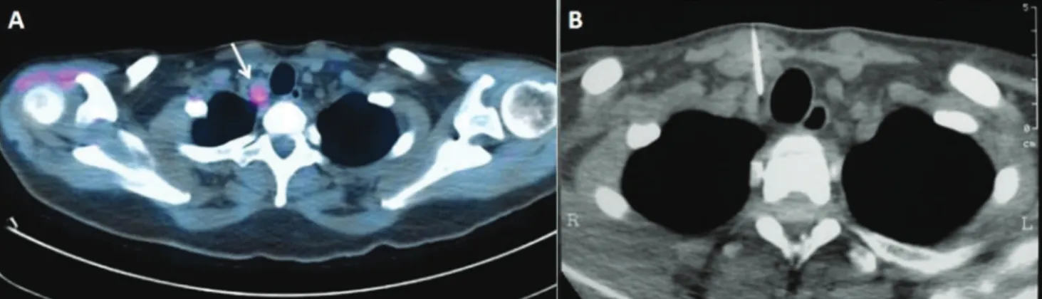 Figure 2 - A) PET-CT demonstrating an anomalous concentration of  18 F-FDG in the enlarged right cervical lymph node (maximum SUV: 1.65)