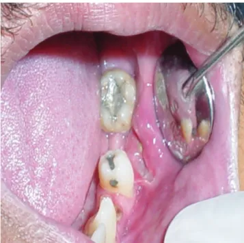 Figure 5 - Necrotic oral mucosal ulceration, possibly associated with CMV  in severe HIV disease