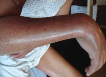 Figure 1 - Thickening and hardening of the skin of the right forearm 