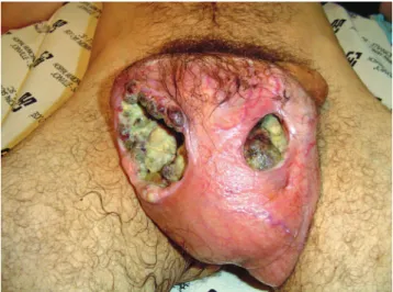 Figure 1 - Extensive necrosis on the right hemiscrotum