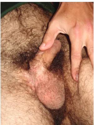 Figure 3 - Complete healing 26 months after excision