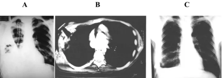 Figure 3 - A: Massive parapneumonic empyema in the right hemithorax. Although adequately drained, the lung did not re-expand and there was some  remaining air-fluid