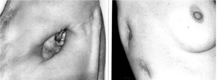 Figure 4 - On the left, a conventional open pleural window scar in a male patient. On the right, the upper scar is after POP removal, and below is a scar  after removal of a regular 36 FR  chest tube