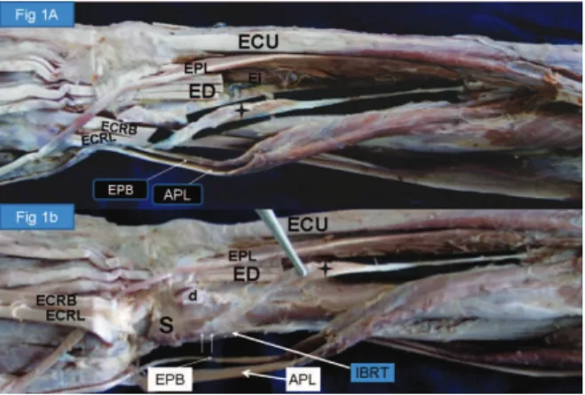 Figure  1  -  The  extensor  compartment  of  the  right  forearm  and  hand,  showing the anomalous muscle