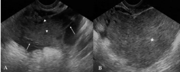 Figure 1 - Transvaginal pelvic ultrasound images (A,B) showed a complex  retrouterine mass with a homogeneous solid component (*, B) and cystic  areas (arrowhead, A) intermingled with linear septa (arrow, A)