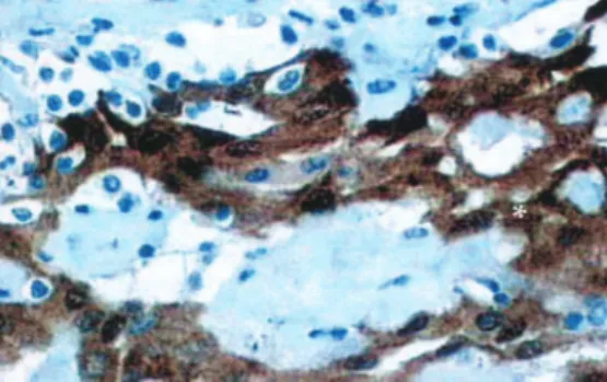 Figure 4 - The histopathologic section shows calretinin staining for well- well-differentiated mesothelial cells (*), which confirms the mesothelial origin  of the tumor