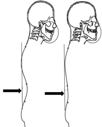 Figure  1  - Correlation  between  craniofacil  parameters  and  back  shape  profiles: patients with distal and vertical craniofacial patterns present higher  than  normal  upper  thoracic,  lumbar-lordotic,  and  pelvic  angles;  patients  with mesial an