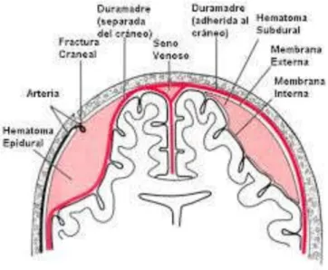 Figura 02: Esquema explicitando o hematoma epidural à esquerda e o hematoma subdural à direita 1