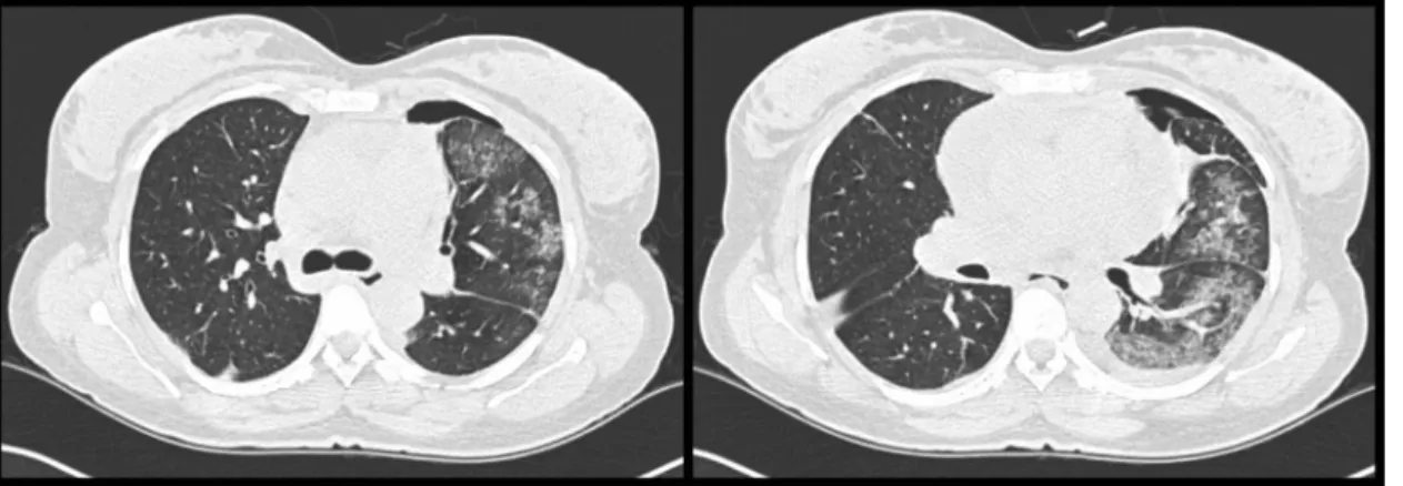 Figure 1 - Computed tomography scans immediately after thoracocentesis showing mild hydro-pneumothorax, ground-glass opacities predominantly in the lingula and left inferior lobe, centrilobular micronodules, and thickening of interlobular septa.