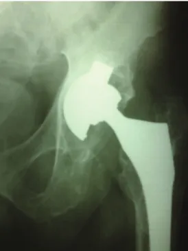 Figure 2 - A plasmacup acetabular component with severe polyethylene wear and osteolysis.