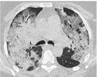 Figure 1 – X-ray computed tomography of the thorax showing diffuse, patchy bilateral ground glass opacities and consolidation at ICU admission.