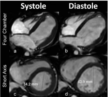 Figure 1 - Magnetic resonance images taken during cardiac systole and end diastole. The images above the plane show four chambers with aneurysmal formation of the left ventricle, and the images below demonstrate ventricular dilation.