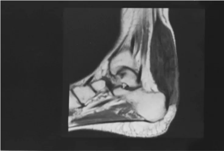Figure 2 - Ankle MRI sagittal section in T1 showing Xanthoma of the Achilles in a patient with CTX.